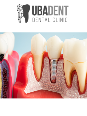 dis implanti ve kopru hangisi daha iyi